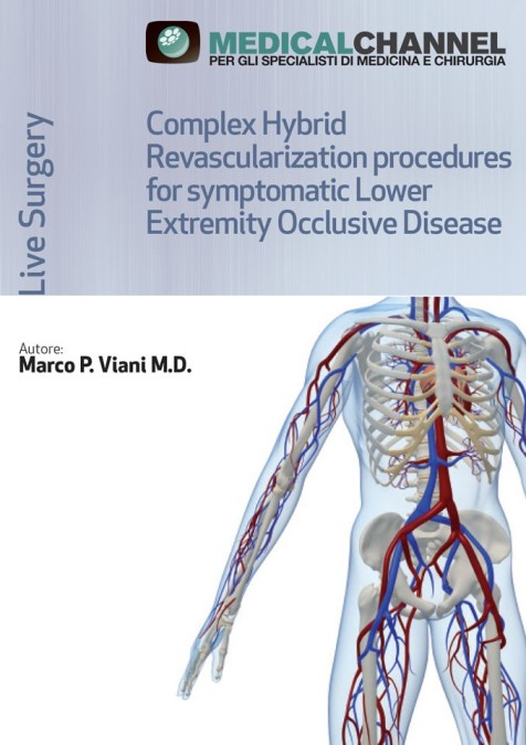 Complex Hybrid Revascularization Procedures